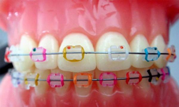 ارتودنسی دندان رنگی