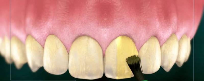 فلورایدتراپی دندان