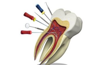 هزینه درمان ریشه دندان