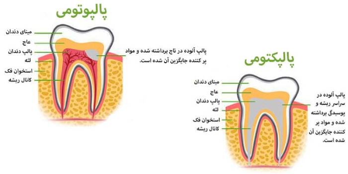 درمان پالپوتومی و پالپکتومی دندان