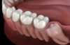 جراحی دندان عقل چگونه انجام می شود
