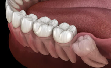 جراحی دندان عقل چگونه انجام می شود
