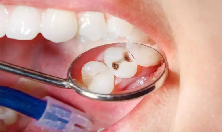علت سوراخ شدن دندان