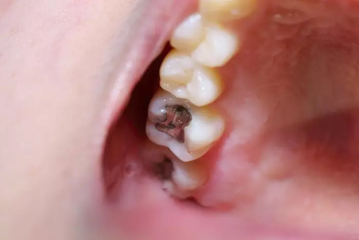 علت سوراخ شدن دندان