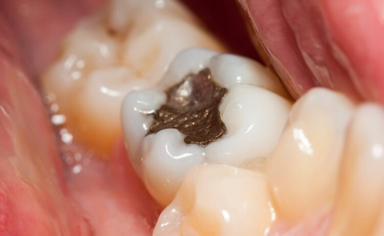 The cause of pain in a filled tooth