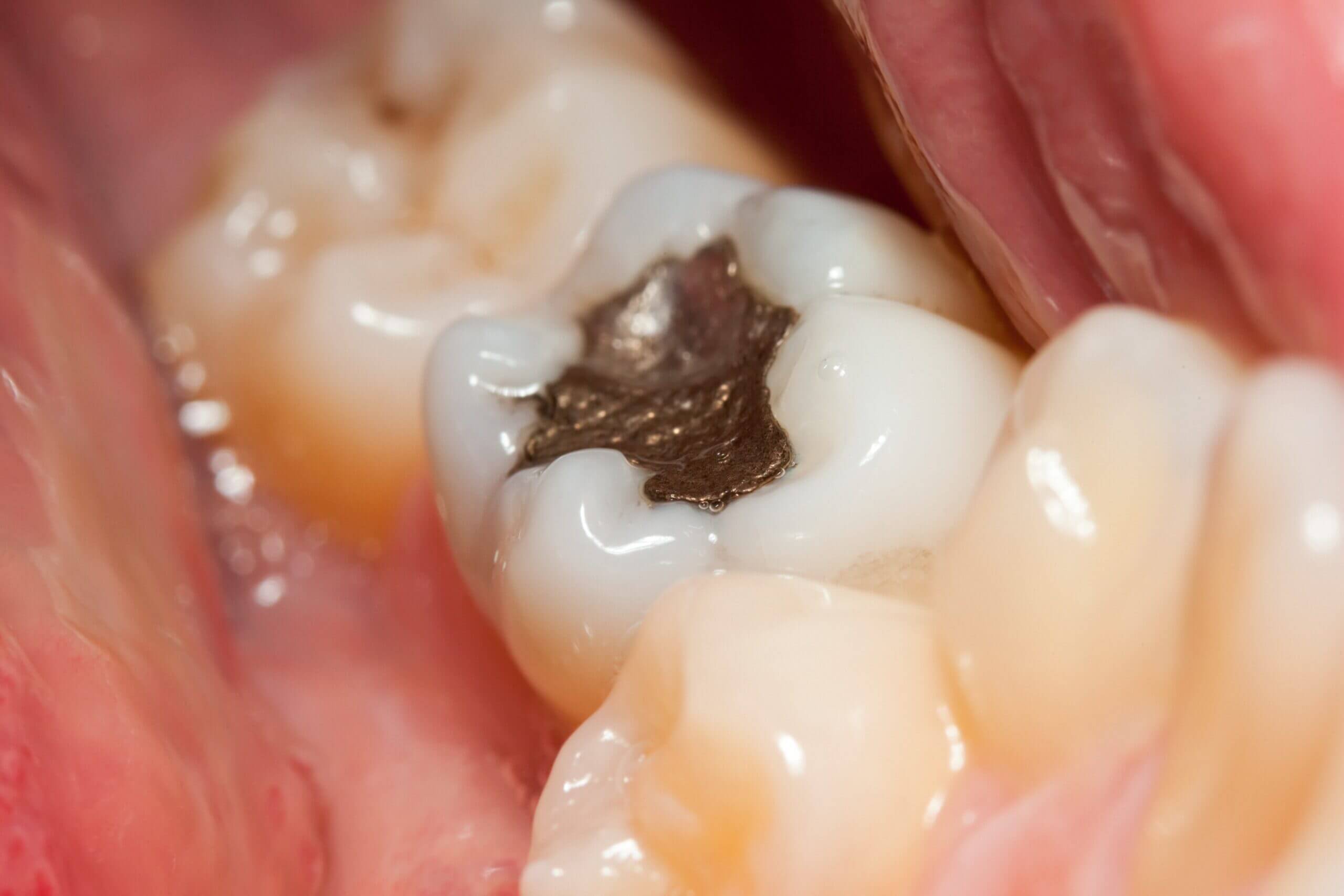 The cause of pain in a filled tooth