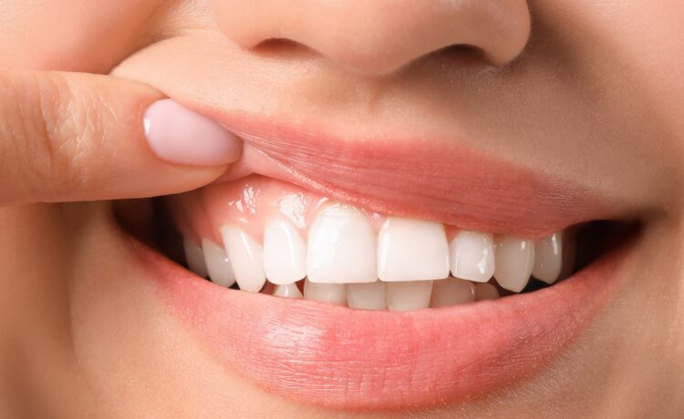 Complications of dental laminate