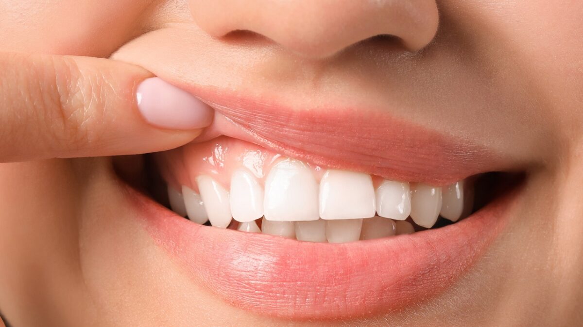 Complications of dental laminate