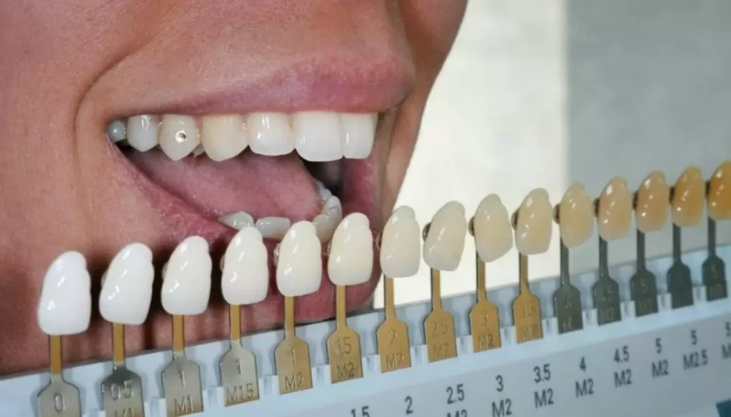 معیارهای مهم در انتخاب رنگ روکش دندان