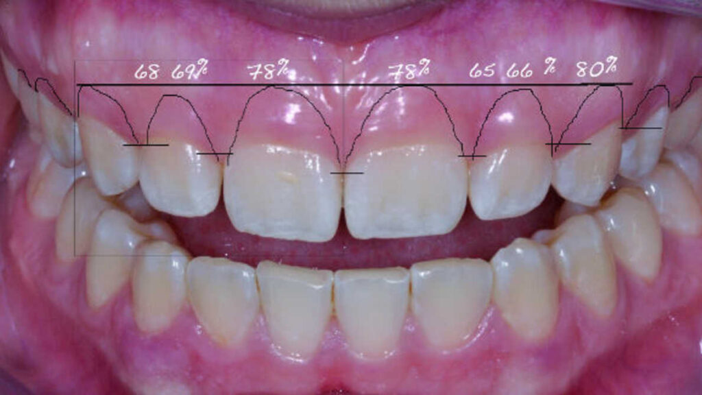آیا قرار دادن تاج دندان با درد همراه است؟