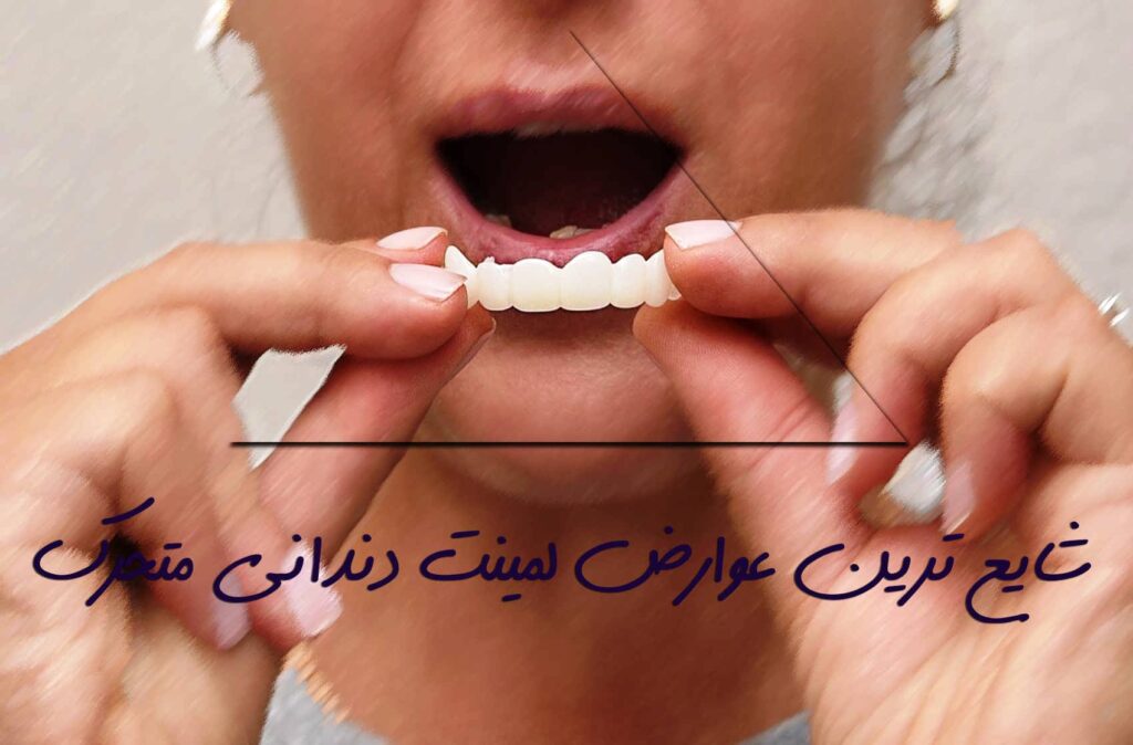 اثرات جانبی پس از نصب لمینت دندان عبارتند از: