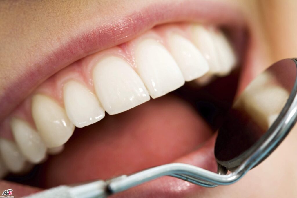 برای نگهداری و پیشگیری از عوارض لمینت دندان