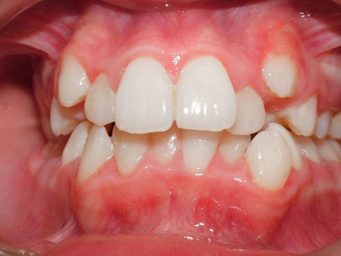 کرادینگ دندان