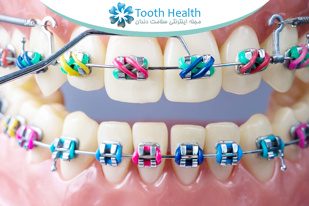 تجهیزات ارتودنسی؛ آشنایی کامل با انواع وسایل و کاربردها