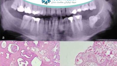 ضایعات هیبریدی ادونتوژنیک: آشنایی با یک چالش نادر در بیماری های فک و صورت