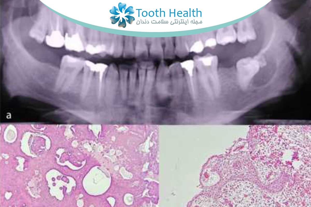 ضایعات هیبریدی ادونتوژنیک: آشنایی با یک چالش نادر در بیماری های فک و صورت