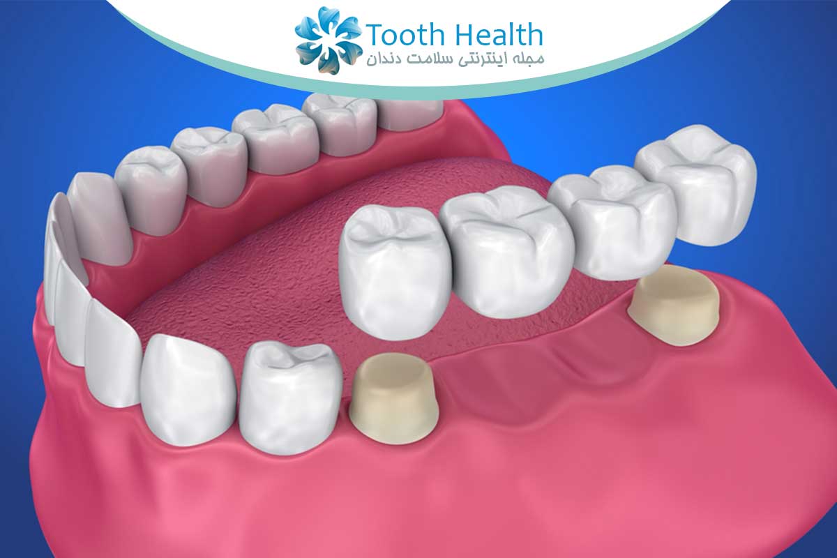 بریج دندان چیست و چه انواعی دارد؟ راهنمای کامل برای بیماران