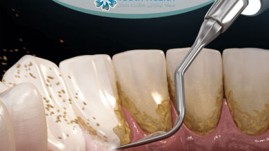 عوارض جرم گیری دندان