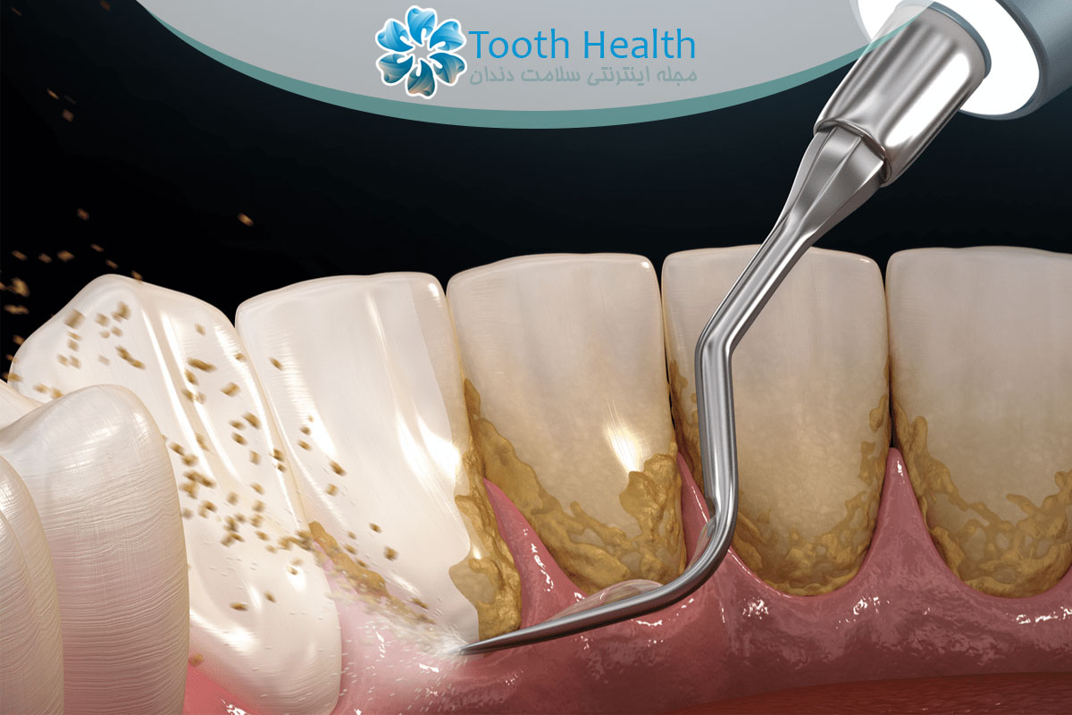 عوارض جرم گیری دندان
