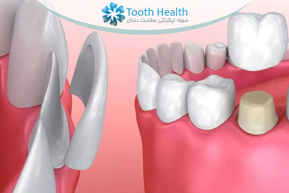 مقایسه روکش یا لمینت؟ مقایسه علمی کاربرد، هزینه، مزایا و معایب