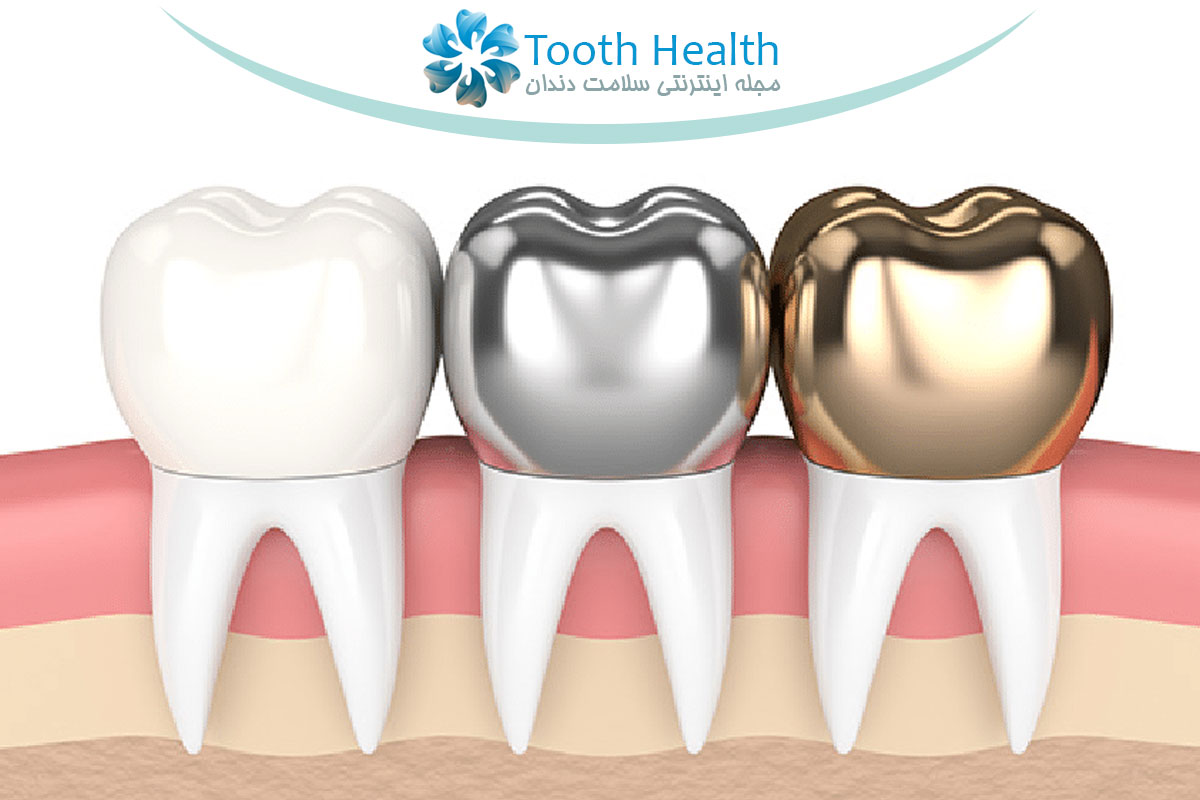 مراقبت از روکش دندان: بهداشت، رژیم غذایی و نکات افزایش ماندگاری