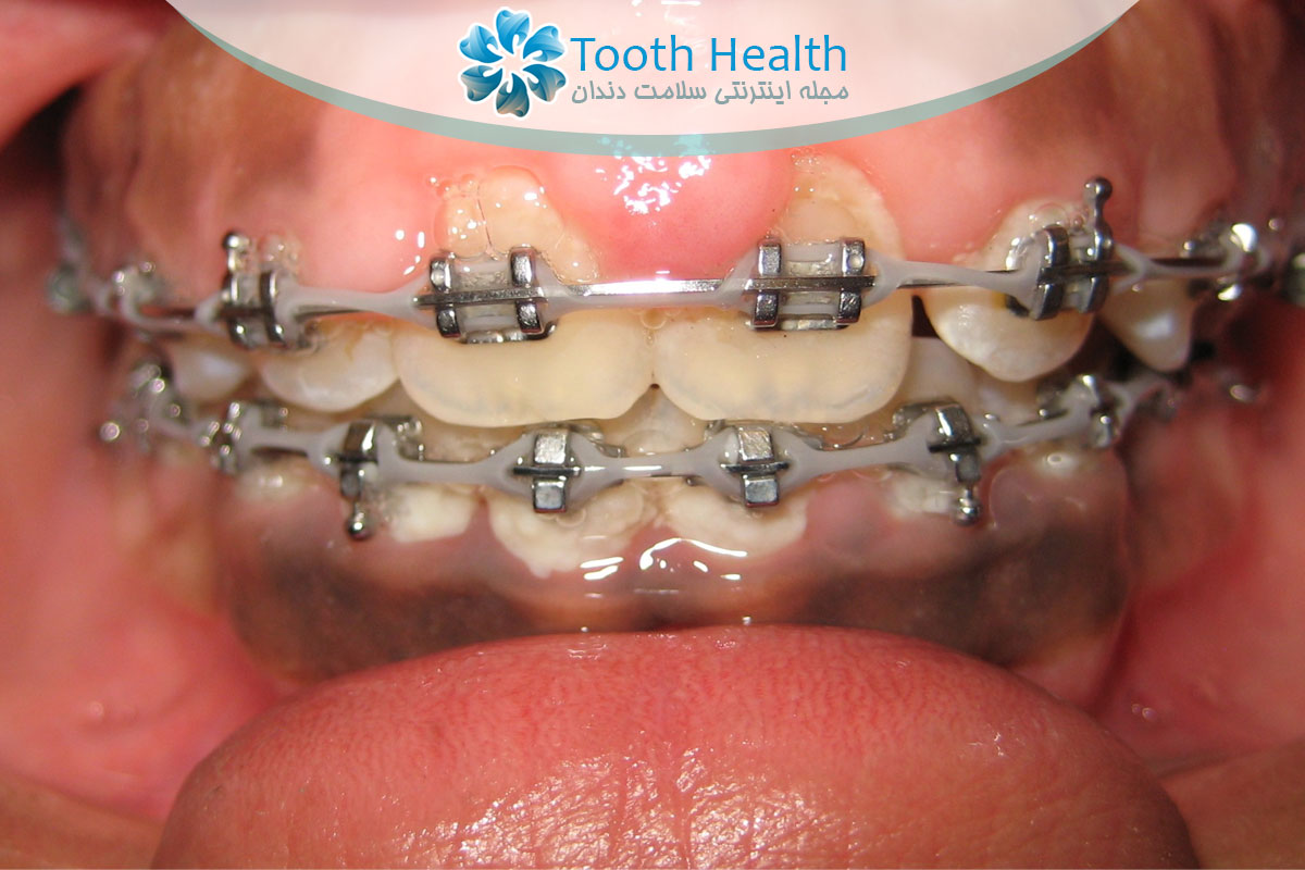 قرمزی، تورم و عفونت لثه بعد از ارتودنسی: علل، پیشگیری و درمان لیزری