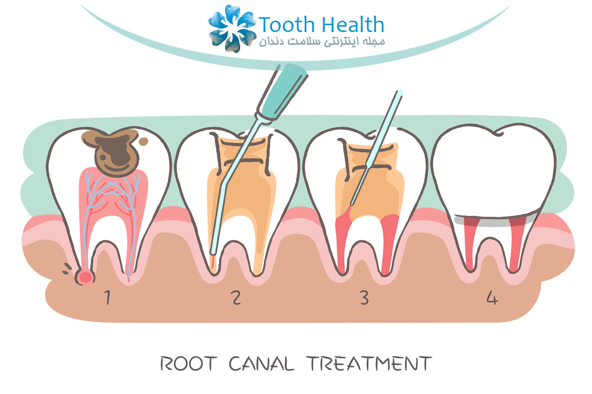 انواع روش های عصب کشی دندان: دستی، روتاری، لیزر و میکروسکوپی