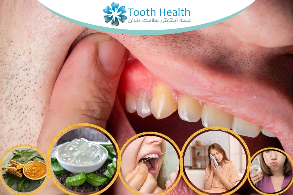 درمان سریع آبسه دندان در منزل