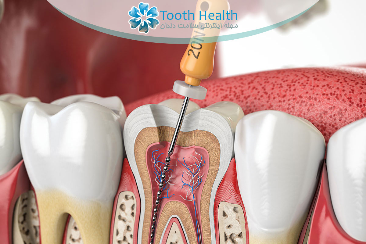 مراحل عصب کشی دندان: از بی حسی تا پر کردن کانال