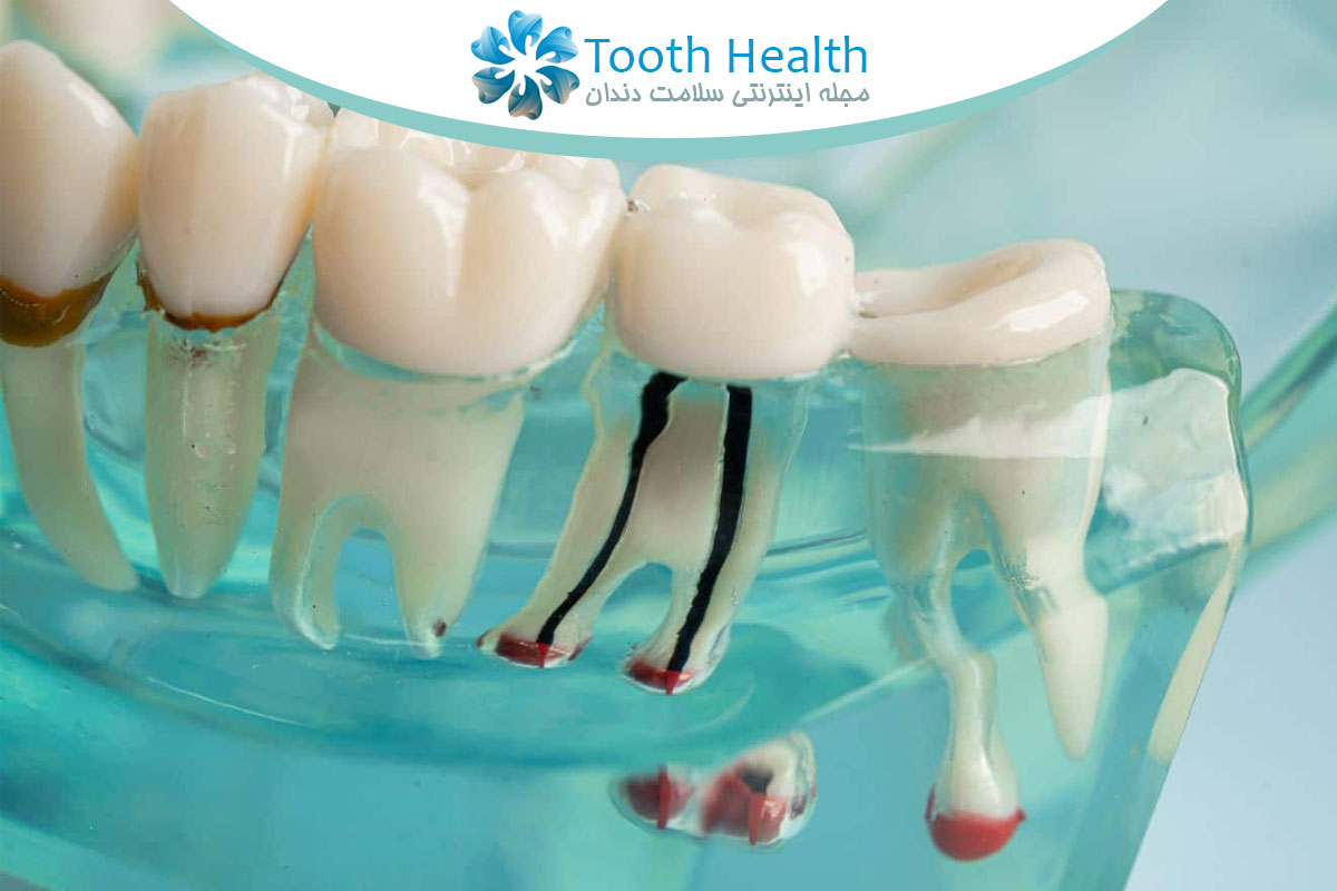 چرا دندان بعد از عصب کشی حساس می‌شود؟