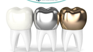 انواع روکش دندان: فلزی، سرامیکی، زیرکونیا و ترکیبی + تصاویر (۱۴۰۴)