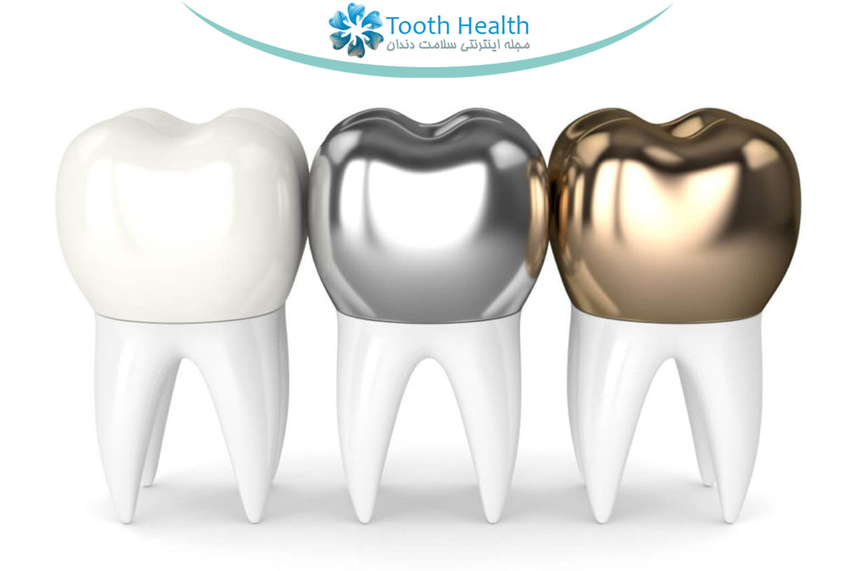 انواع روکش دندان: فلزی، سرامیکی، زیرکونیا و ترکیبی + تصاویر (۱۴۰۴)