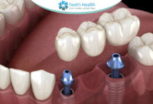 مشکلات شایع بریج دندان، دلایل شل شدن و راهکارهای درمانی