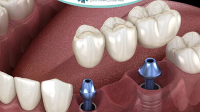 مشکلات شایع بریج دندان، دلایل شل شدن و راهکارهای درمانی