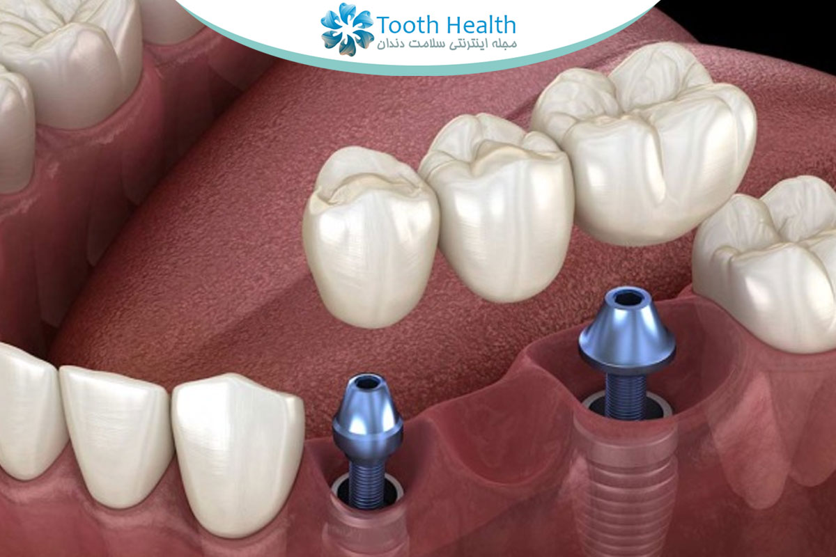 مشکلات شایع بریج دندان، دلایل شل شدن و راهکارهای درمانی