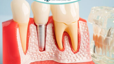 ایمپلنت دندان برای بیماران دیابتی و مبتلایان به بیماری های مزمن: نکات و مراقبت ها