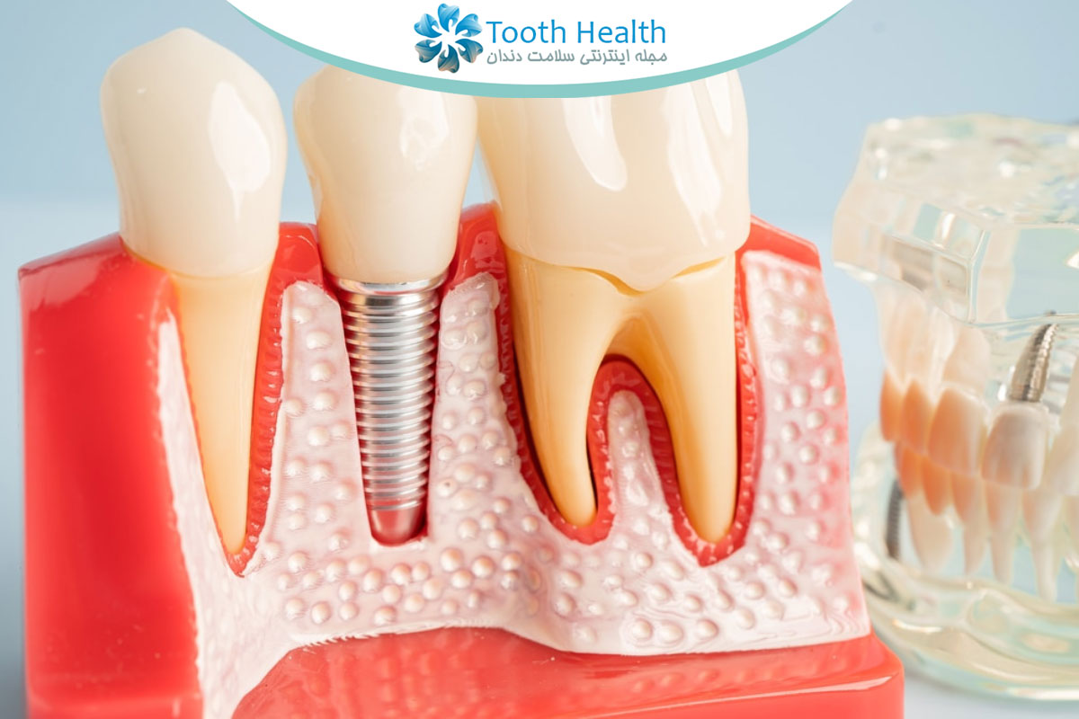 ایمپلنت دندان برای بیماران دیابتی و مبتلایان به بیماری های مزمن: نکات و مراقبت ها