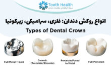 انواع روکش دندان: فلزی، سرامیکی، زیرکونیا و ترکیبی + تصاویر (۱۴۰۴)