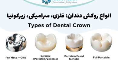 انواع روکش دندان: فلزی، سرامیکی، زیرکونیا و ترکیبی + تصاویر (۱۴۰۴)