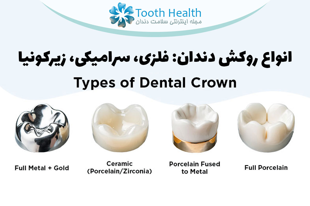 انواع روکش دندان: فلزی، سرامیکی، زیرکونیا و ترکیبی + تصاویر (۱۴۰۴)