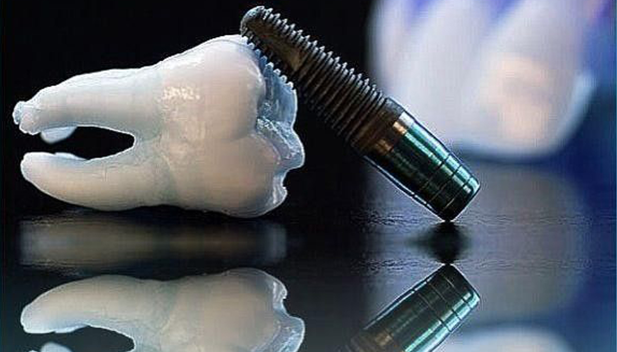 ایمپلنت فوری دندان در اصفهان؛ برای چه کسانی مناسب است