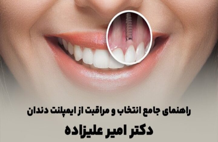 راهنمای جامع انتخاب و مراقبت از ایمپلنت دندان دکتر امیر علیزاده
