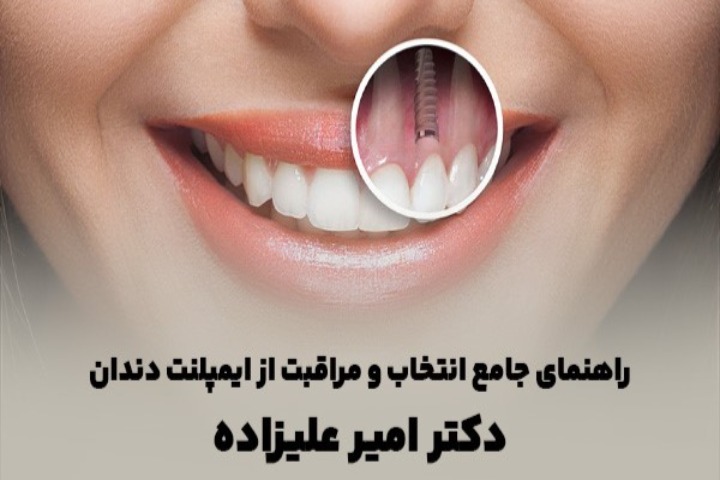 راهنمای جامع انتخاب و مراقبت از ایمپلنت دندان دکتر امیر علیزاده