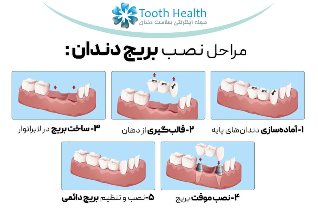 مراحل نصب بریج دندان