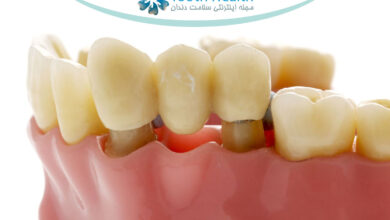 مراحل نصب بریج دندان؛ از قالب گیری تا قرارگیری نهایی روی دندان