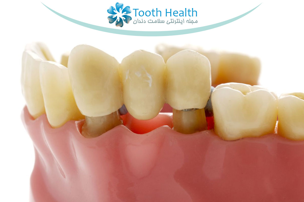 مراحل نصب بریج دندان؛ از قالب گیری تا قرارگیری نهایی روی دندان