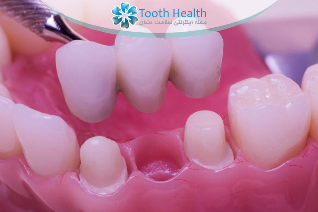 نصب بریج دندان