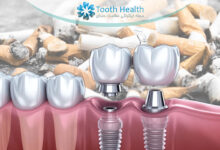 ایمپلنت دندان برای افراد سیگاری؛ ریسک ها، مراقبت ها و توصیه های تخصصی