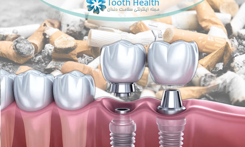ایمپلنت دندان برای افراد سیگاری؛ ریسک ها، مراقبت ها و توصیه های تخصصی