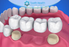 عوارض پروتز و بریج دندان: التهاب لثه، لق شدن، حساسیت و راه‌های پیشگیری